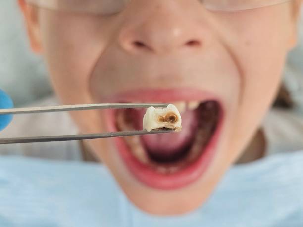 Best Emergency Treatment for Dental Infections or Abscesses in Arden Hills, MN